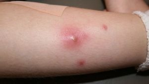 10 Biến chứng nguy hiểm của bệnh tiểu đường