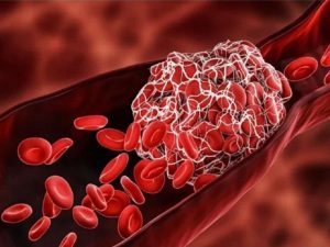 Nguyên nhân hình thành cục máu đông