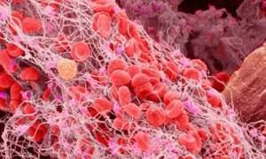 Phương pháp điều trị cục máu đông