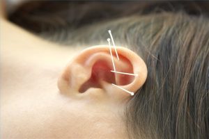 Phương pháp châm cứu có tác dụng trên người bị điếc đột ngột